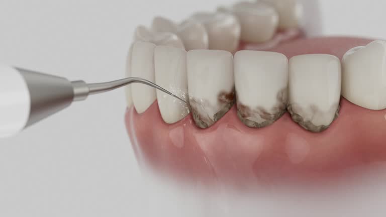 Trusted Teeth Cleaning And Checkup service in Mehlville, MO - Dentist Open Now